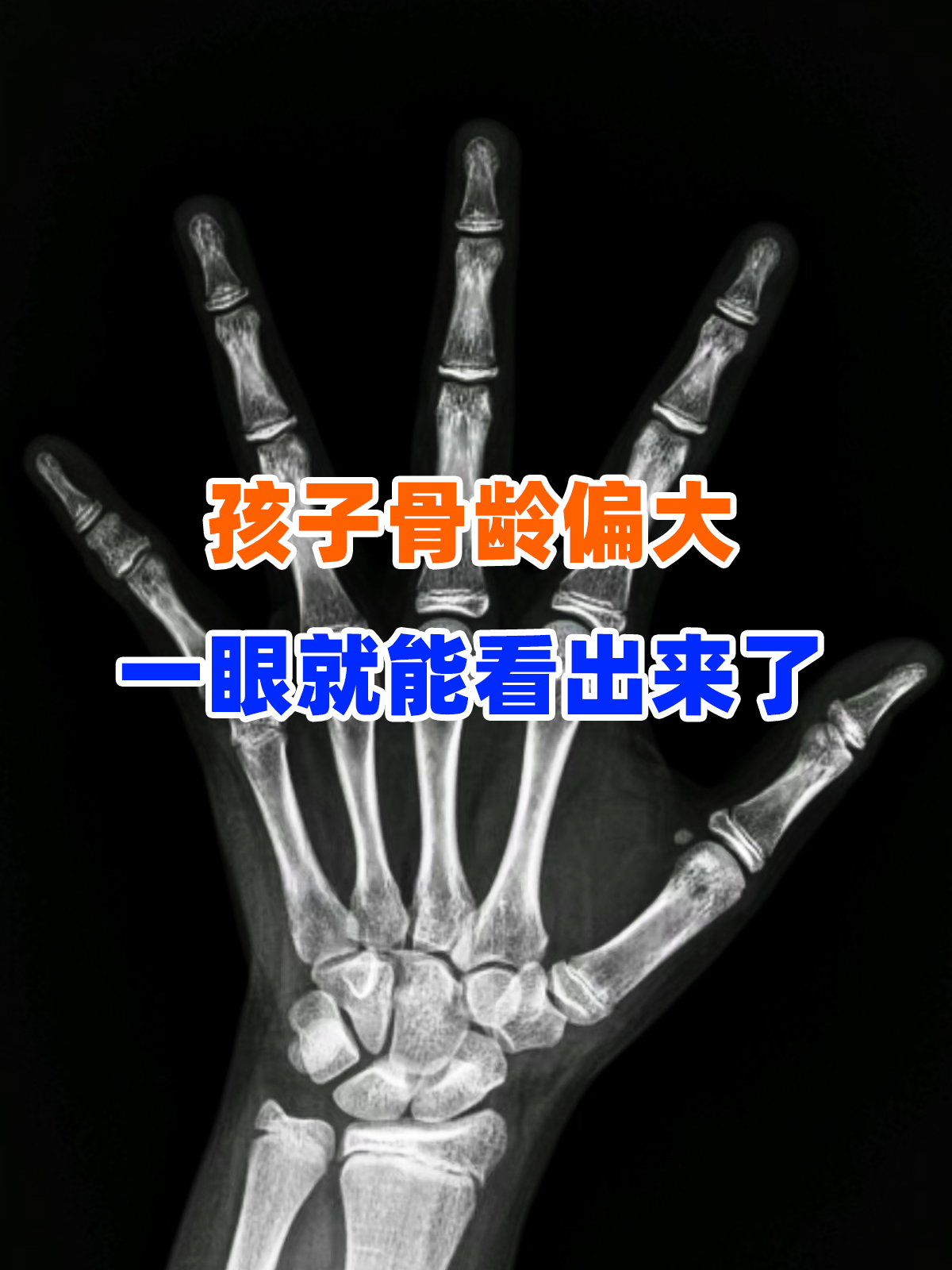 孩子骨龄偏大一眼就能看出来了