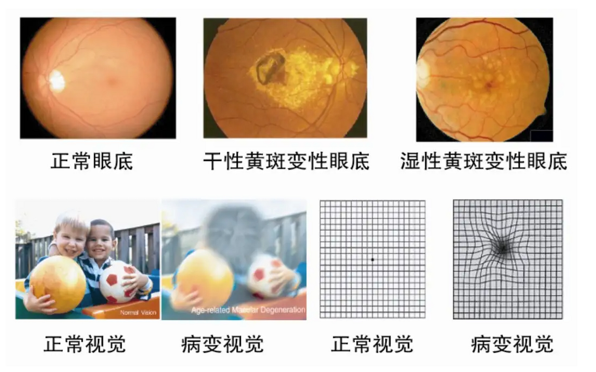 羟氯喹眼底病变图片