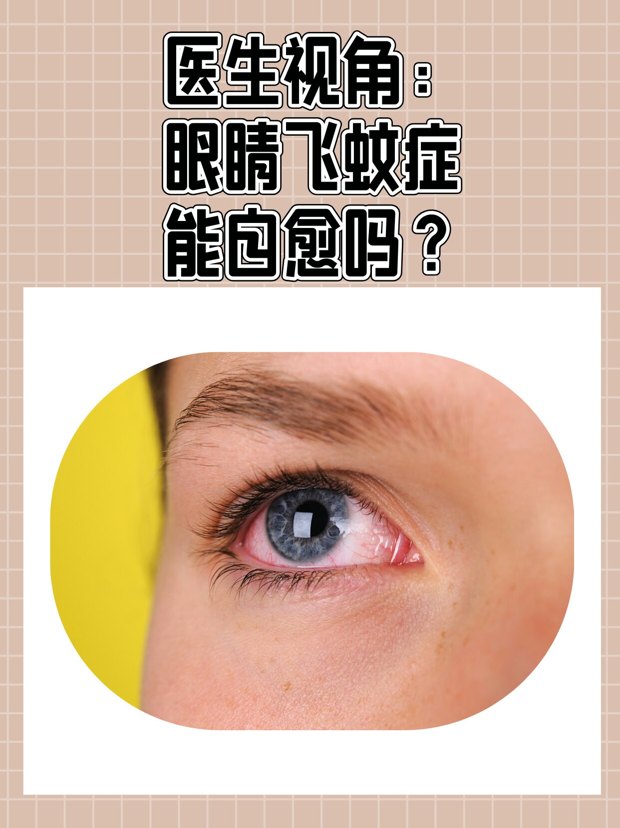 医生视角:眼睛飞蚊症能自愈吗?