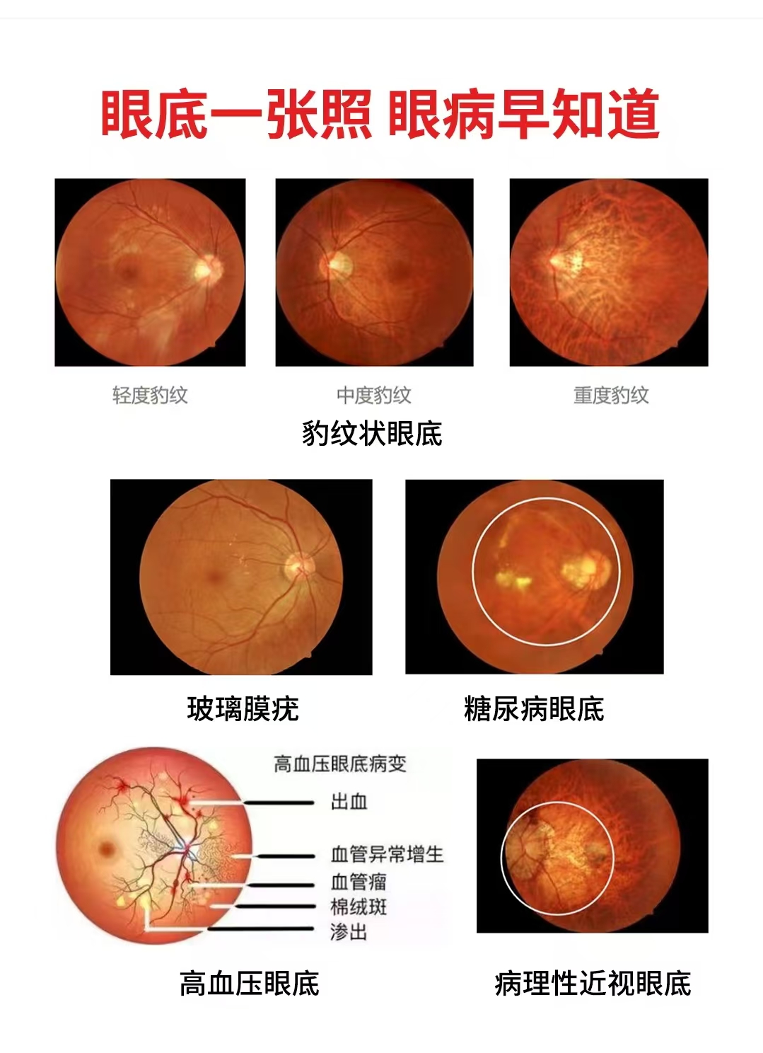 眼底一张照 眼病早知道