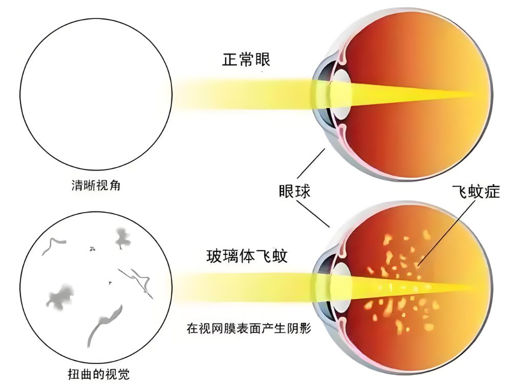 年轻人为何容易产生飞蚊症?