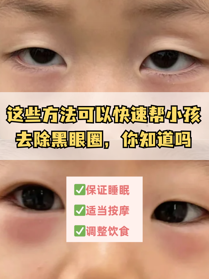 你知道吗 小孩的黑眼圈可能是营养不良,睡眠不足等因素引起的