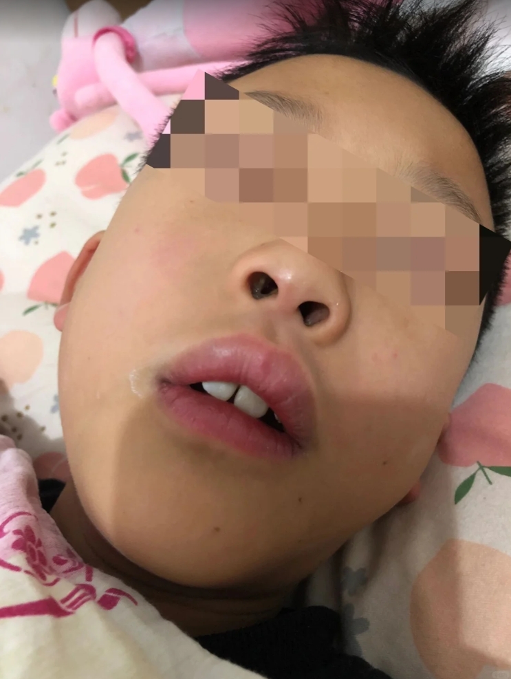 腺样体作为儿童免疫器官,常因反复感染而病理性