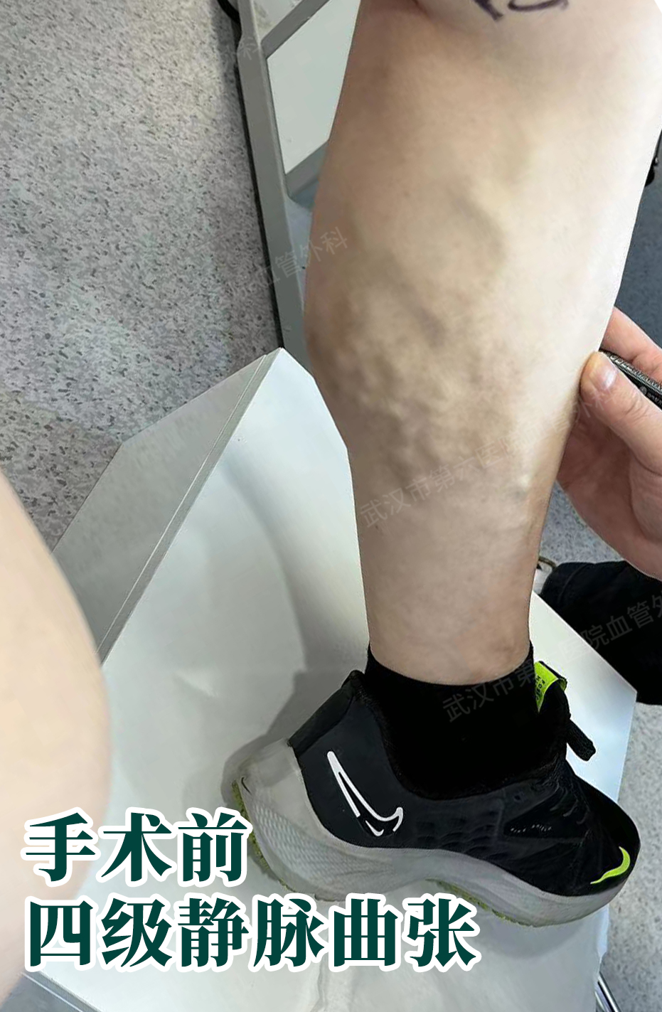 57岁交警大哥,自述治疗静脉曲张全过程:30分钟微创不用开刀