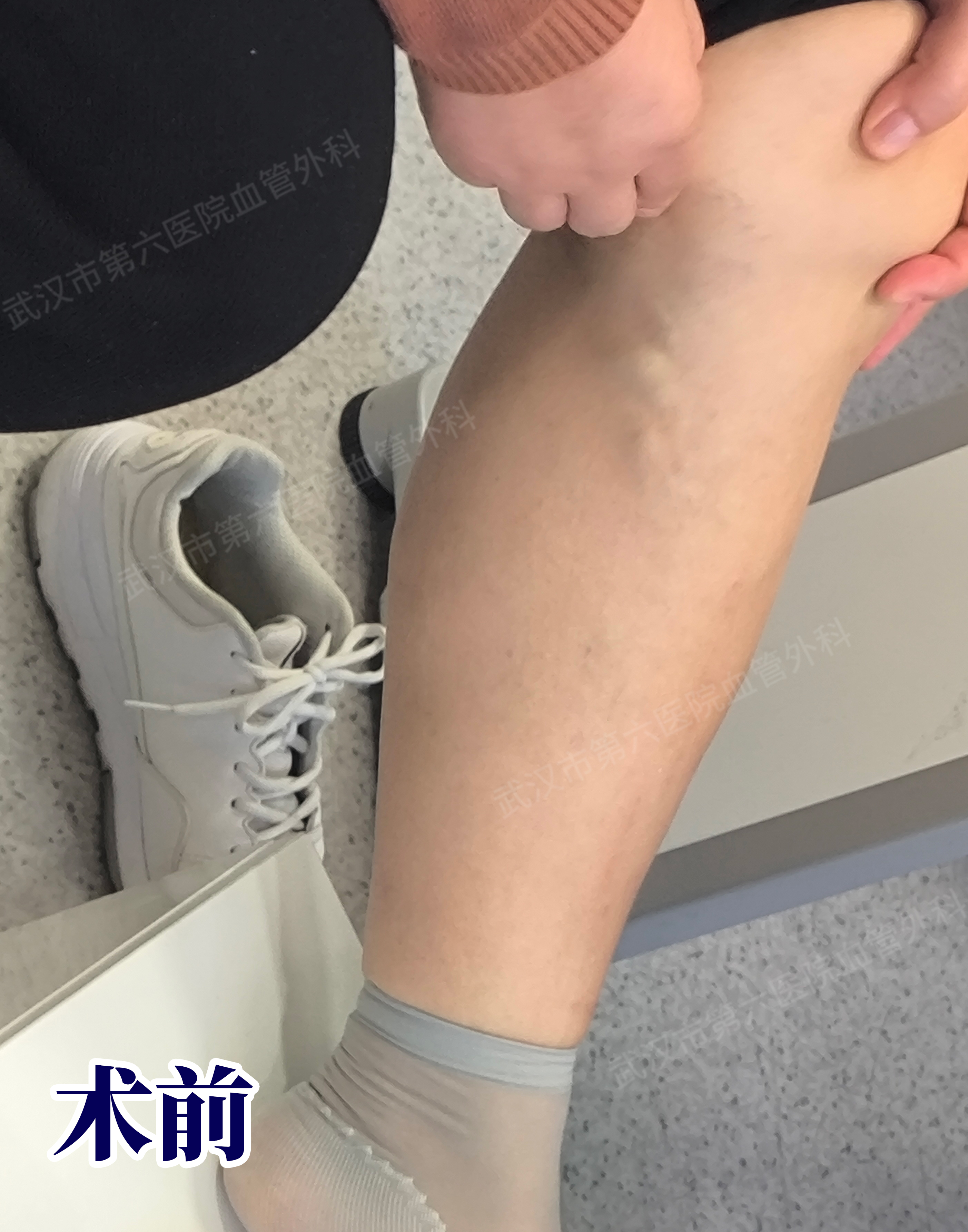 三年前,我的静脉曲张加重,腿胀,沉重,吃药之后还是不舒肪猜銮判⊥ 