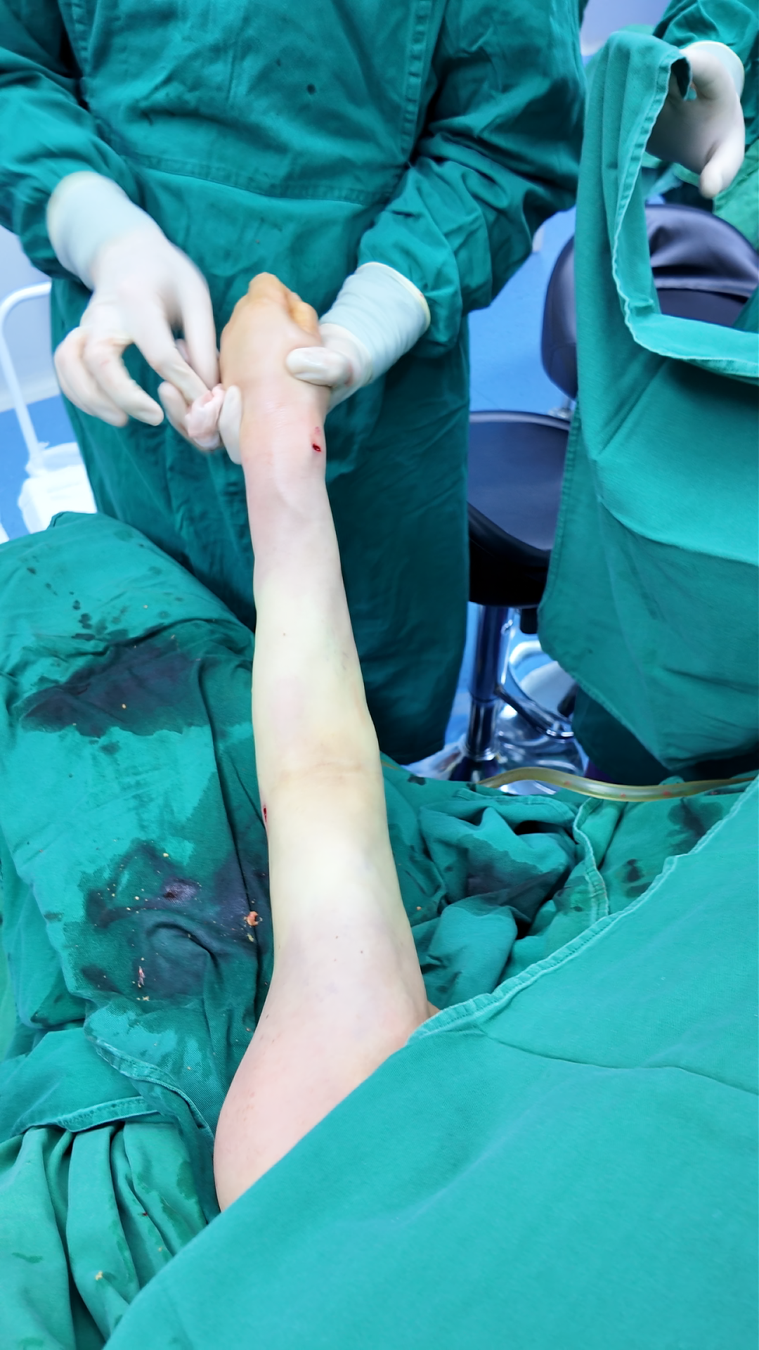 上肢淋巴水肿,是一位55岁患者乳腺癌手术4年,水肿是2年开始的,发红