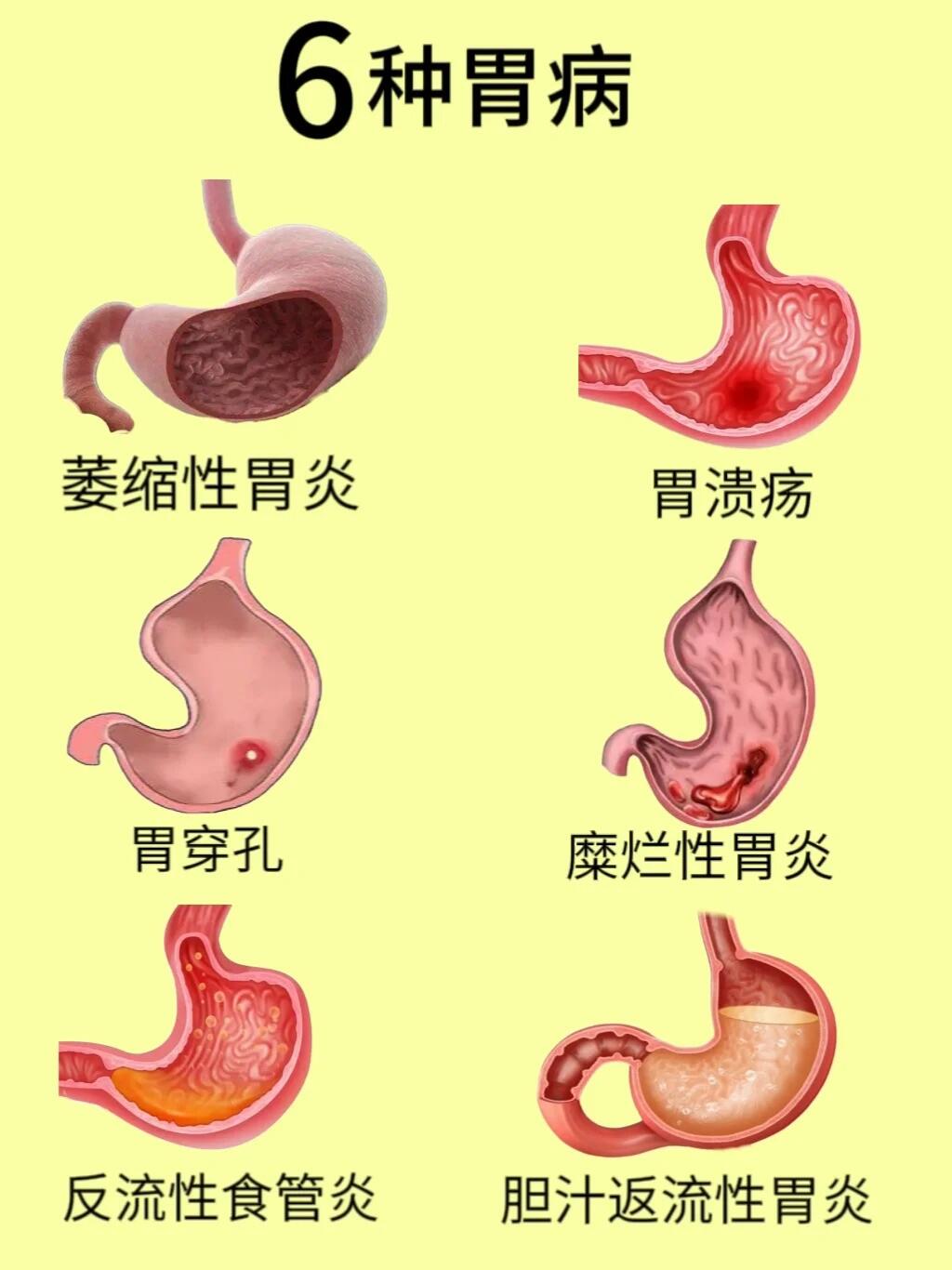 6种胃病!你有这些症状吗?