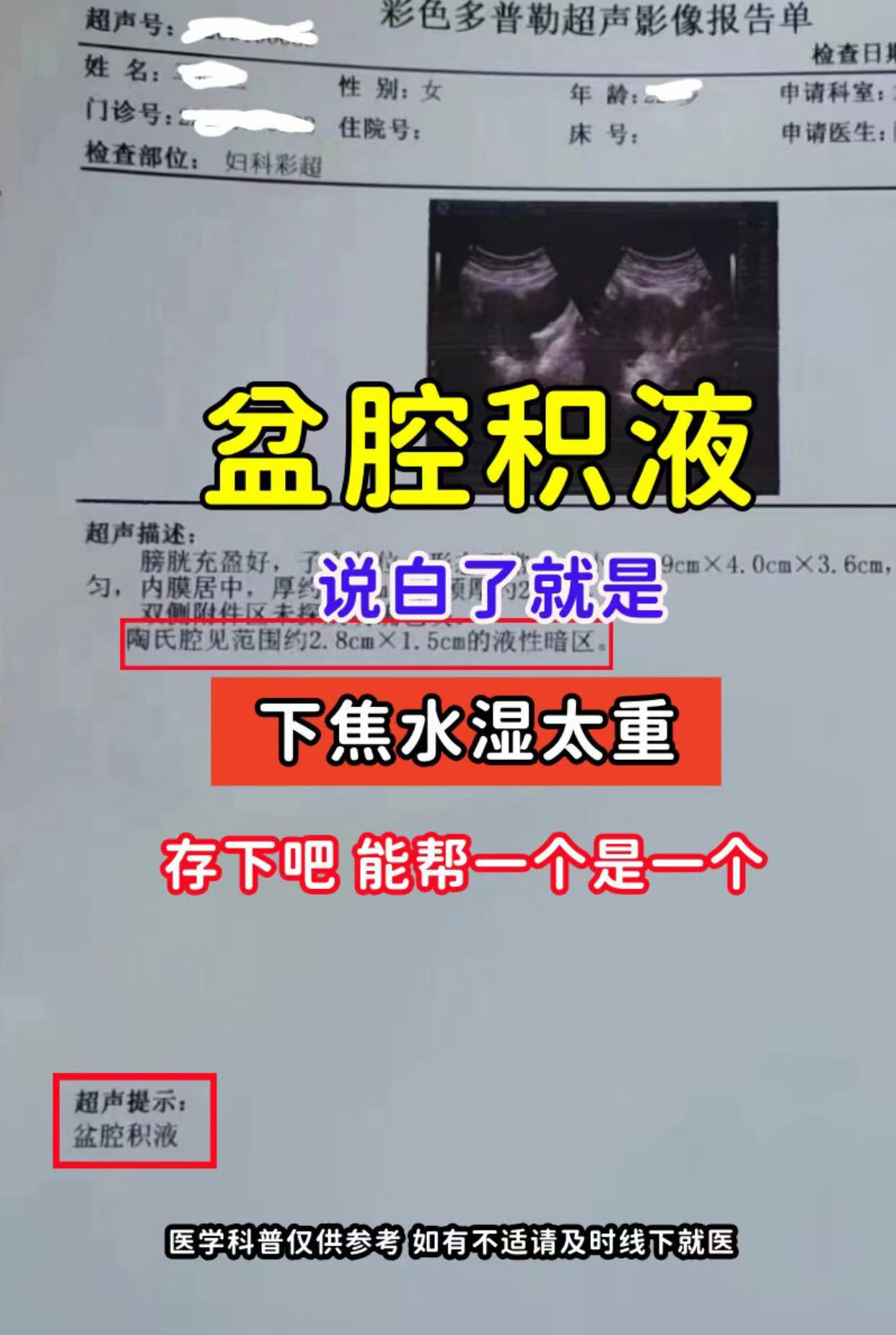【盆腔积液,说白了就是下焦水湿太重,存下吧,能帮一个是一个】  盆腔