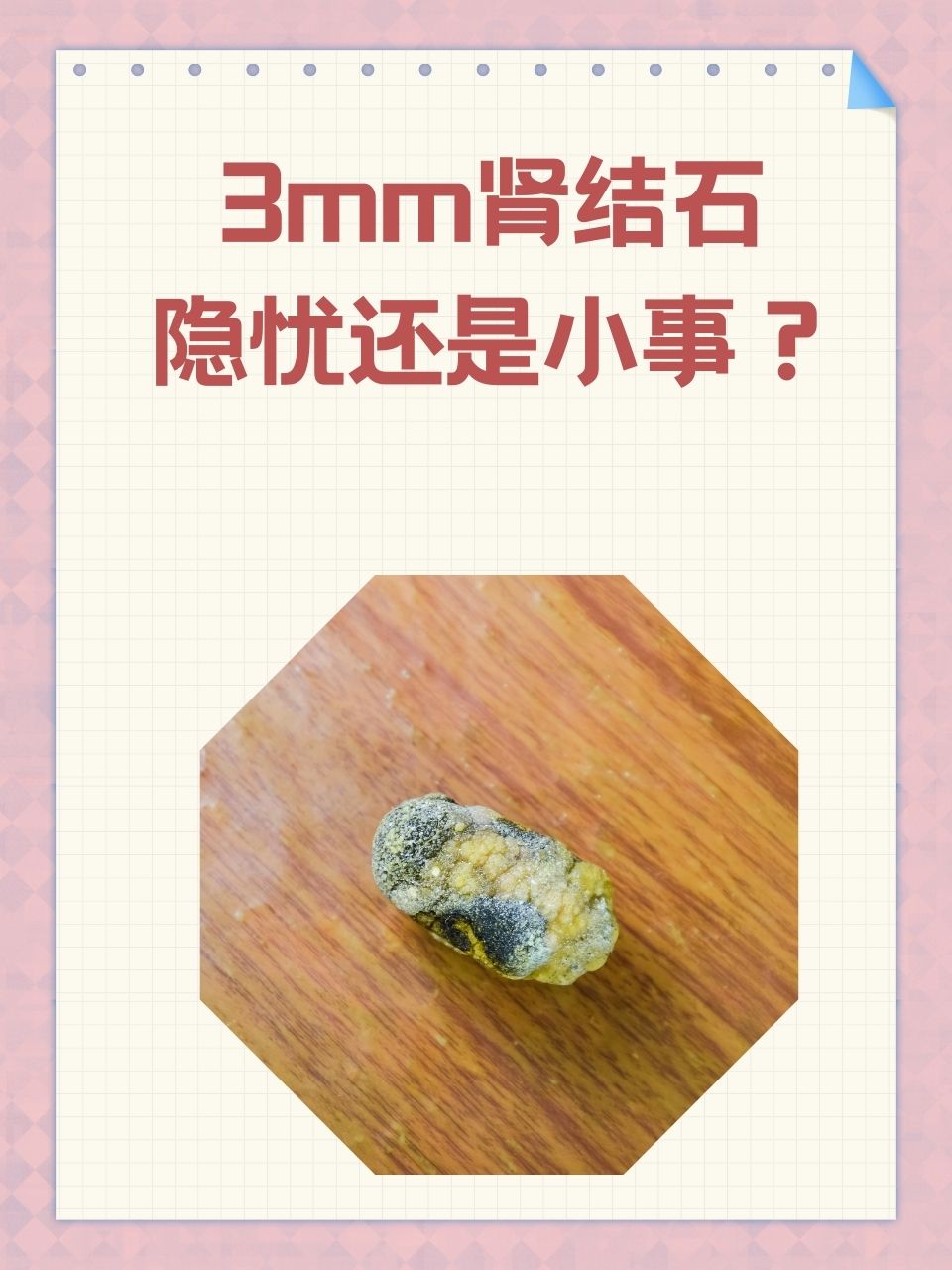 肾结石3x2mm图片图片