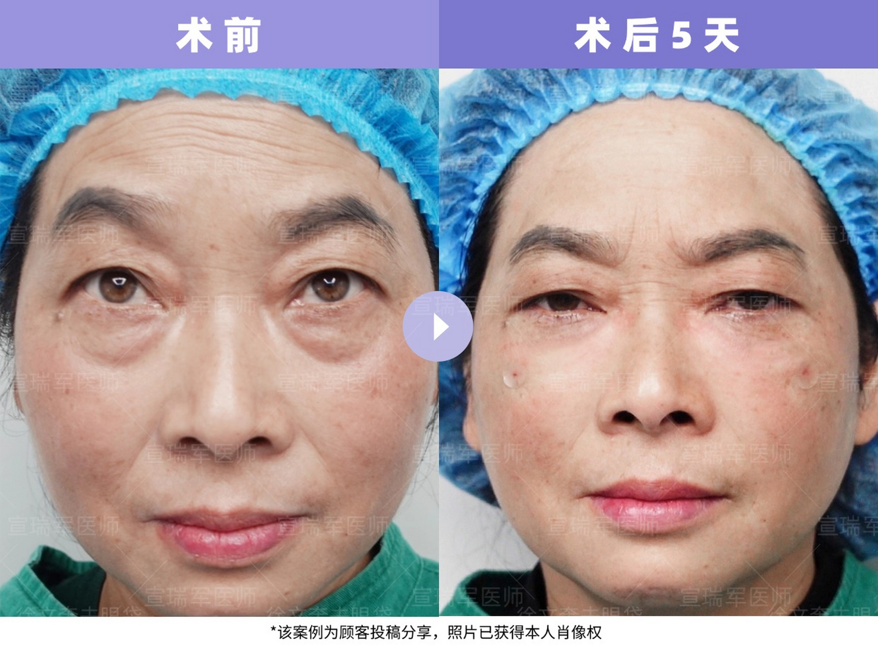 这位女性31岁,眼袋伴随泪沟凹陷,眼部皮肤松驰也明显,下垂感较重,黑