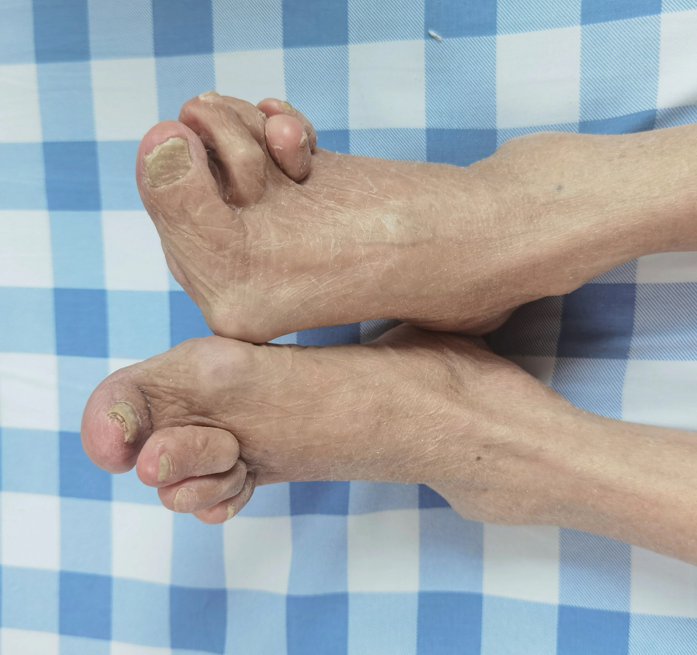 7年生活不能自理  大家好,今天给大家分享一个类风湿的病人,这个病