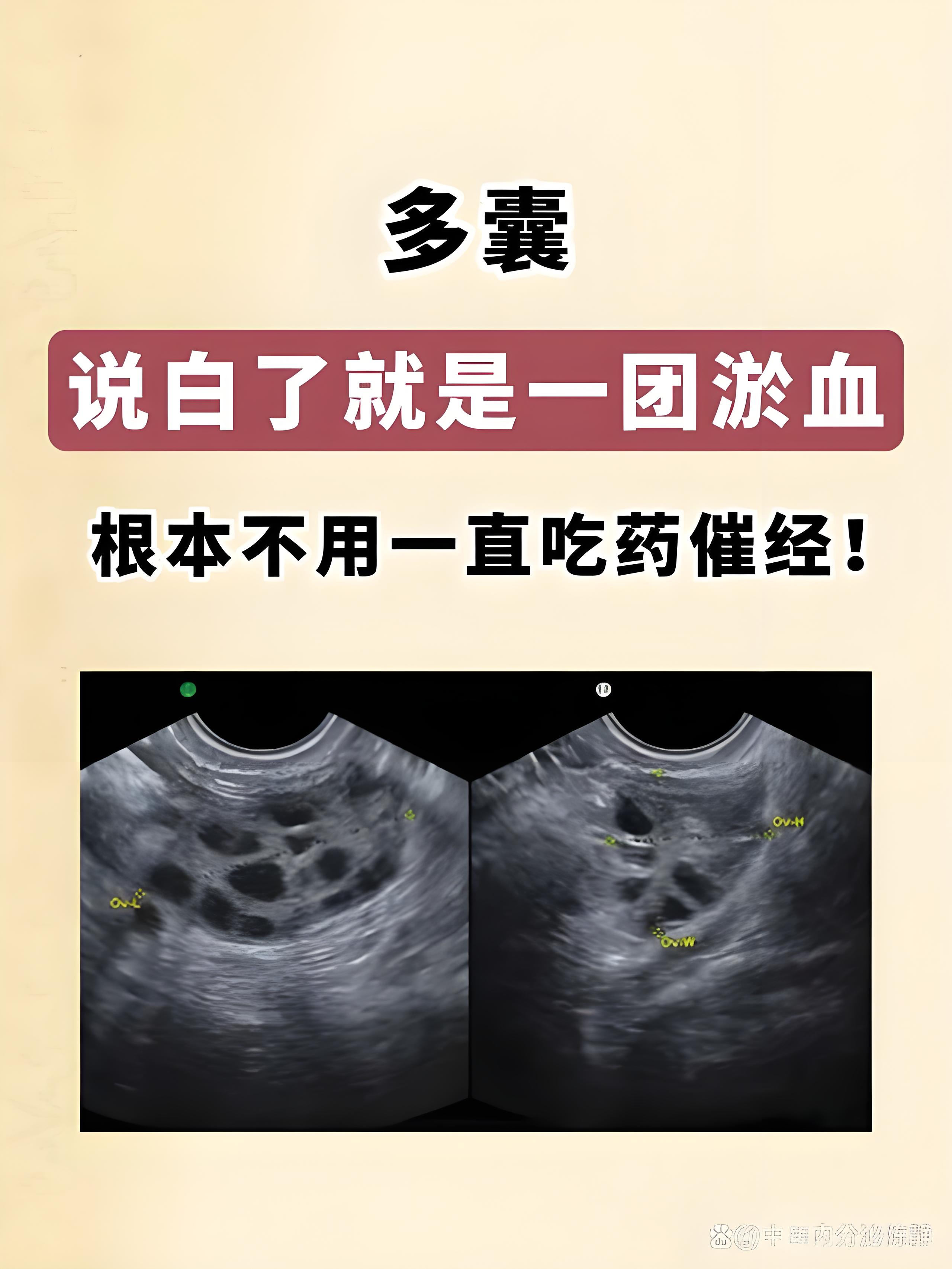 多囊会有怀孕吗_多囊会怀孕吗怎么调理