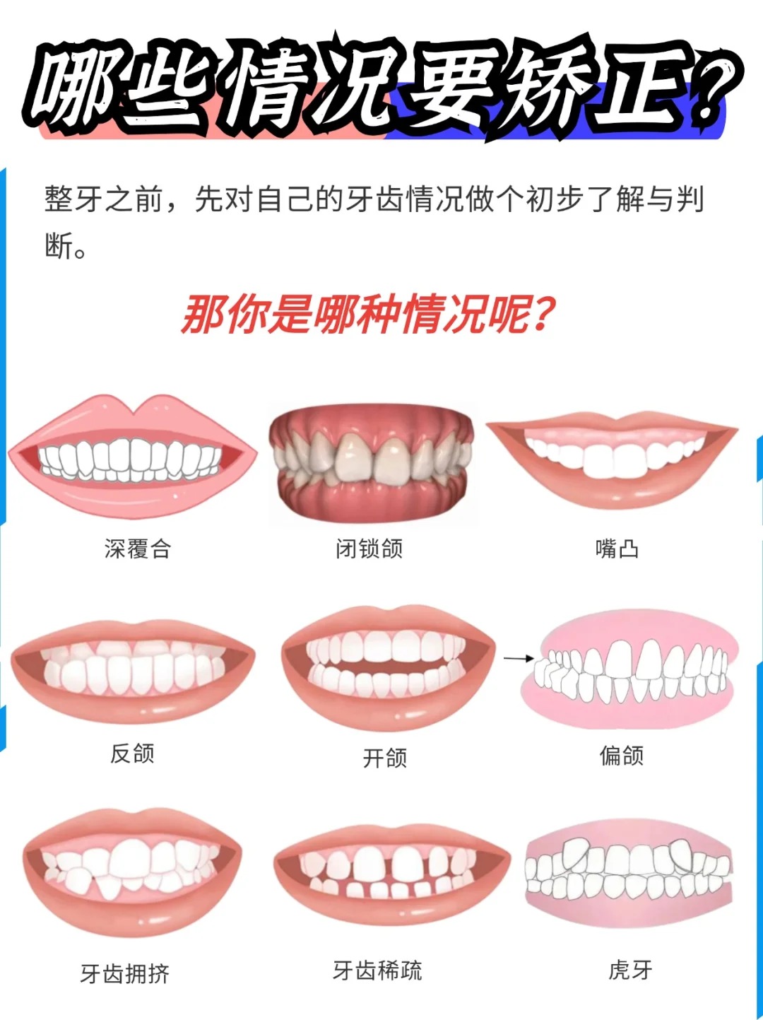 时代天使隐形牙套型号有哪些?怎么选?