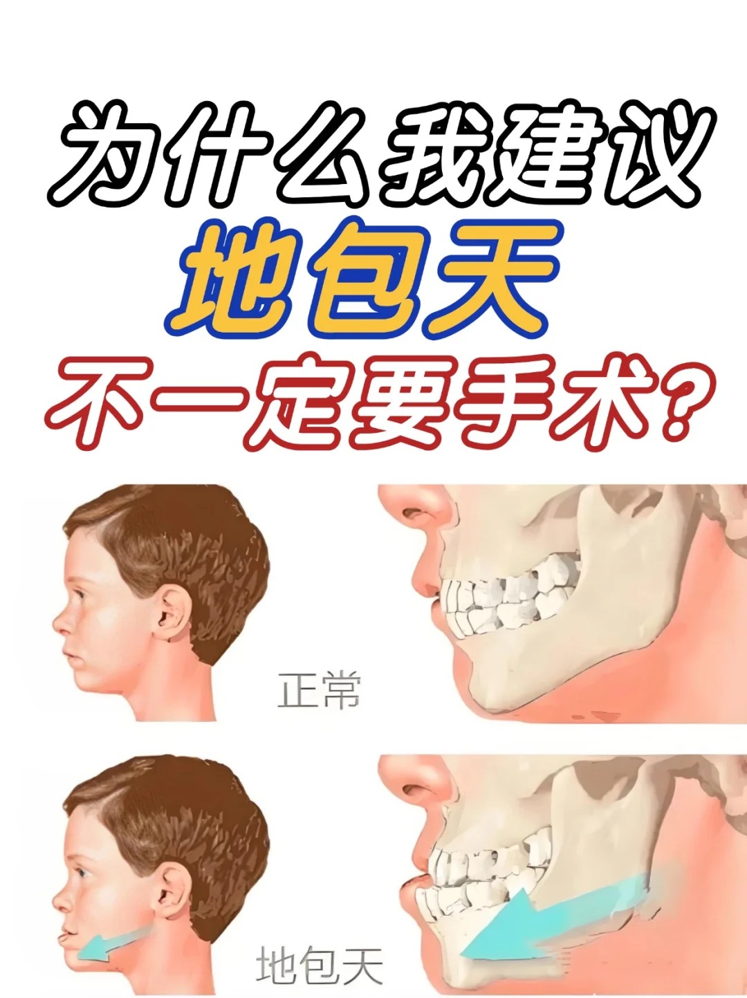 地包天分三种,哪种情况不需要做手术?