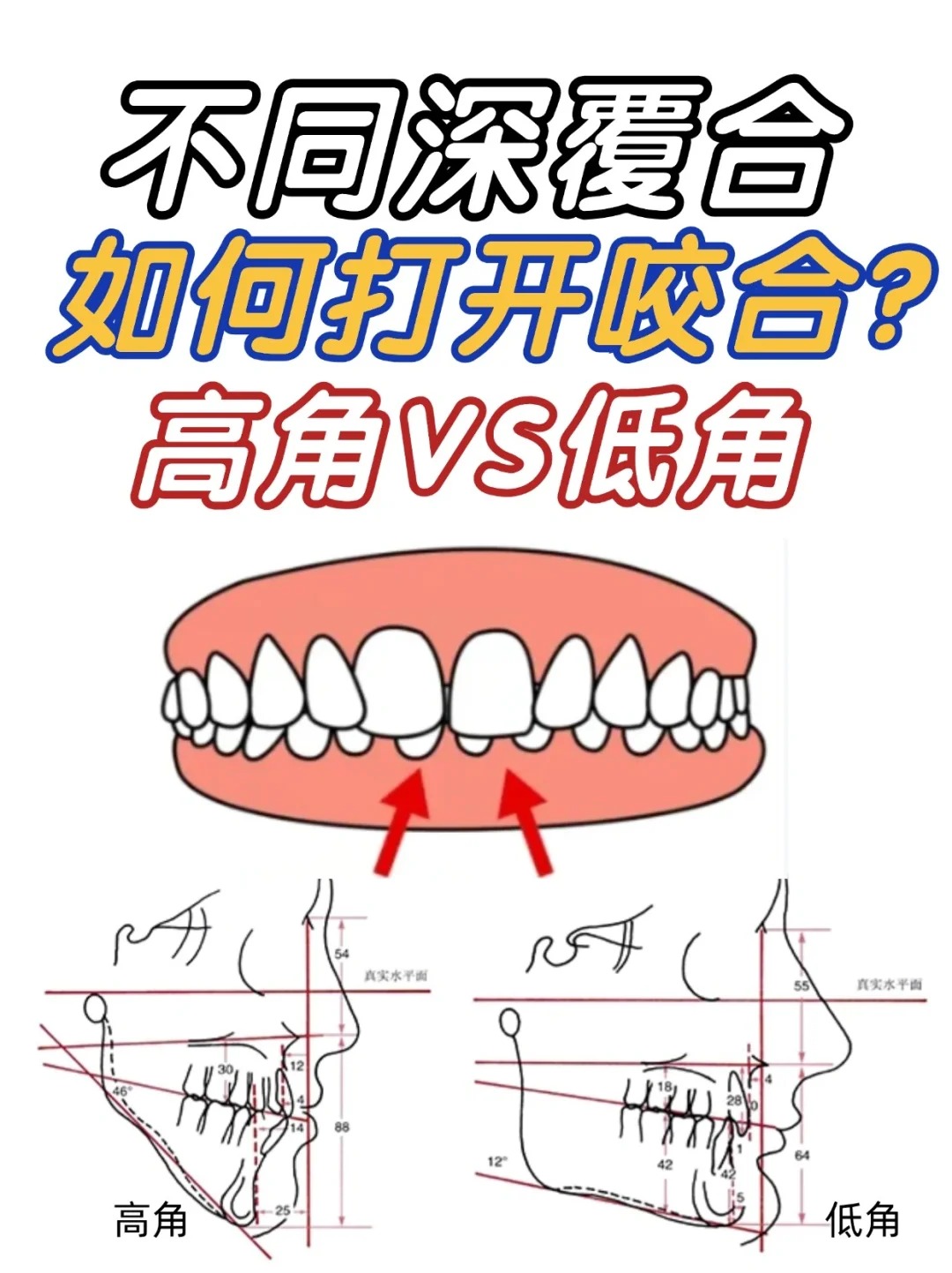 高角深覆合和低角深覆合有什么区别?
