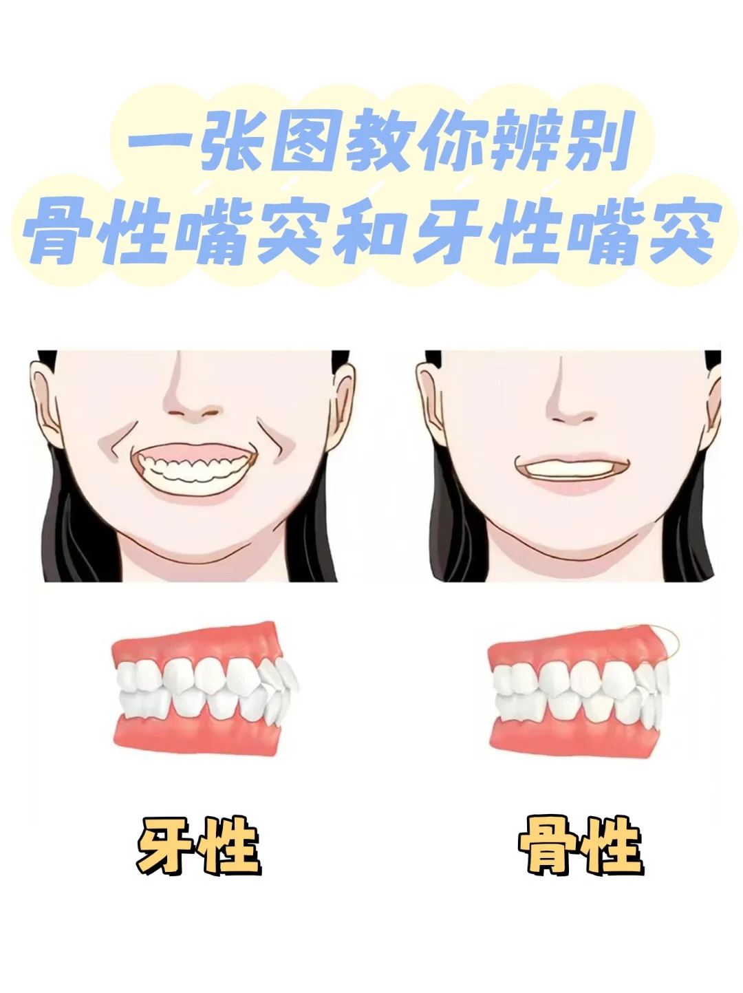 正常嘴型的对比骨性凸嘴和牙性凸嘴的区别轻微凸嘴和严重对比牙齿骨突
