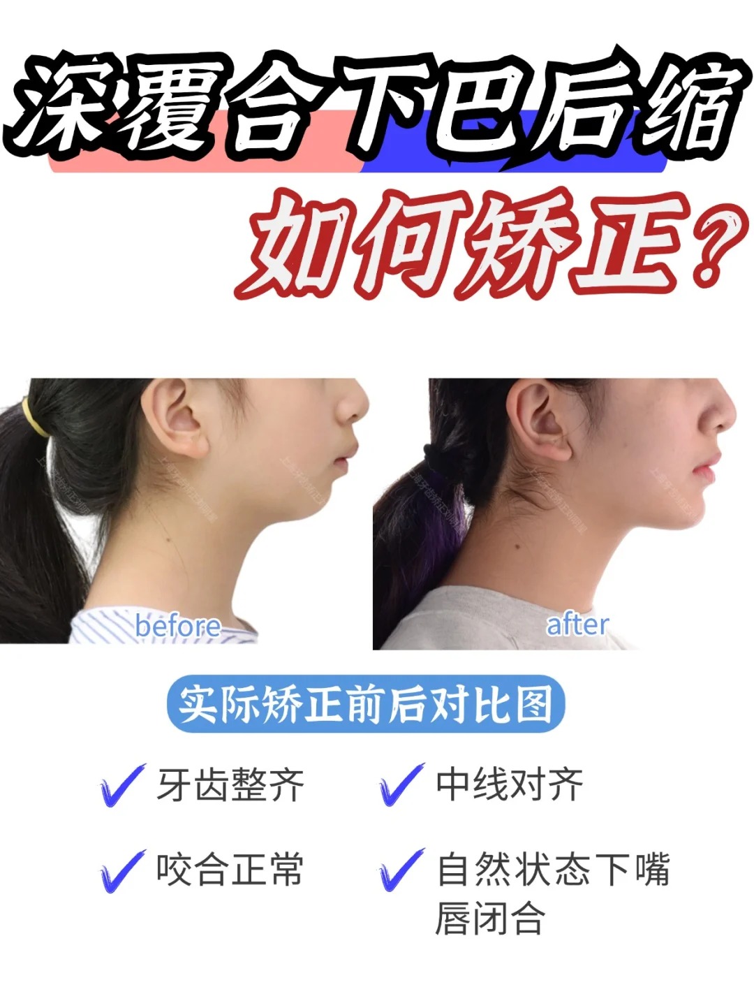 今天分享一个深覆合下巴后缩的案例