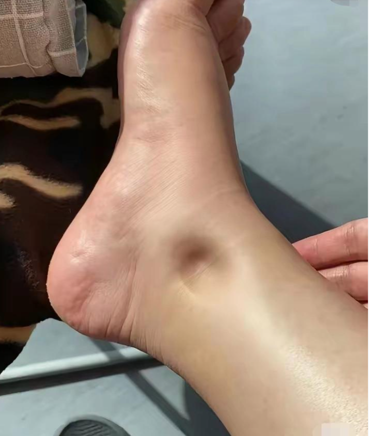 昨天发现我的,有一点水肿,用手一按就是一个坑,不知道怎么回事,也不疼