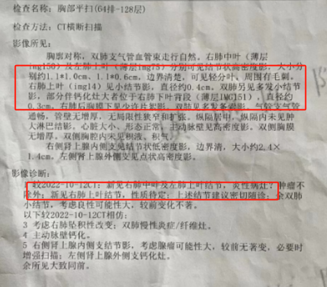 多发11mm肺结节伴毛刺,分叶2年,治疗后结节缩小至5mm以下,毛刺,分叶