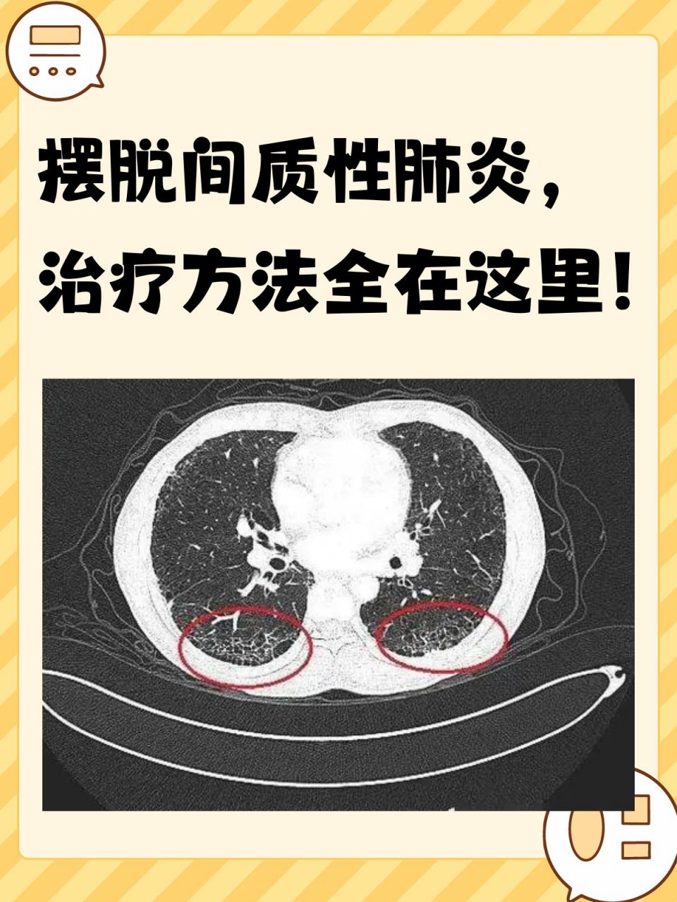 96间质性肺炎是多种原因引起的肺间质炎性和纤维化疾病,病变主要