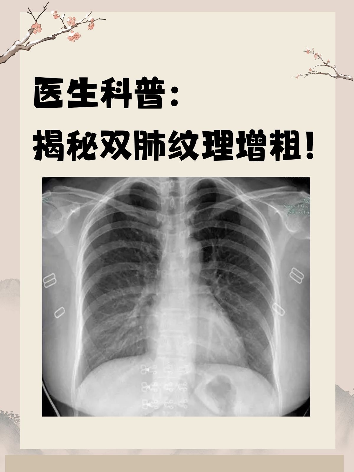 医生科普揭秘双肺纹理增粗