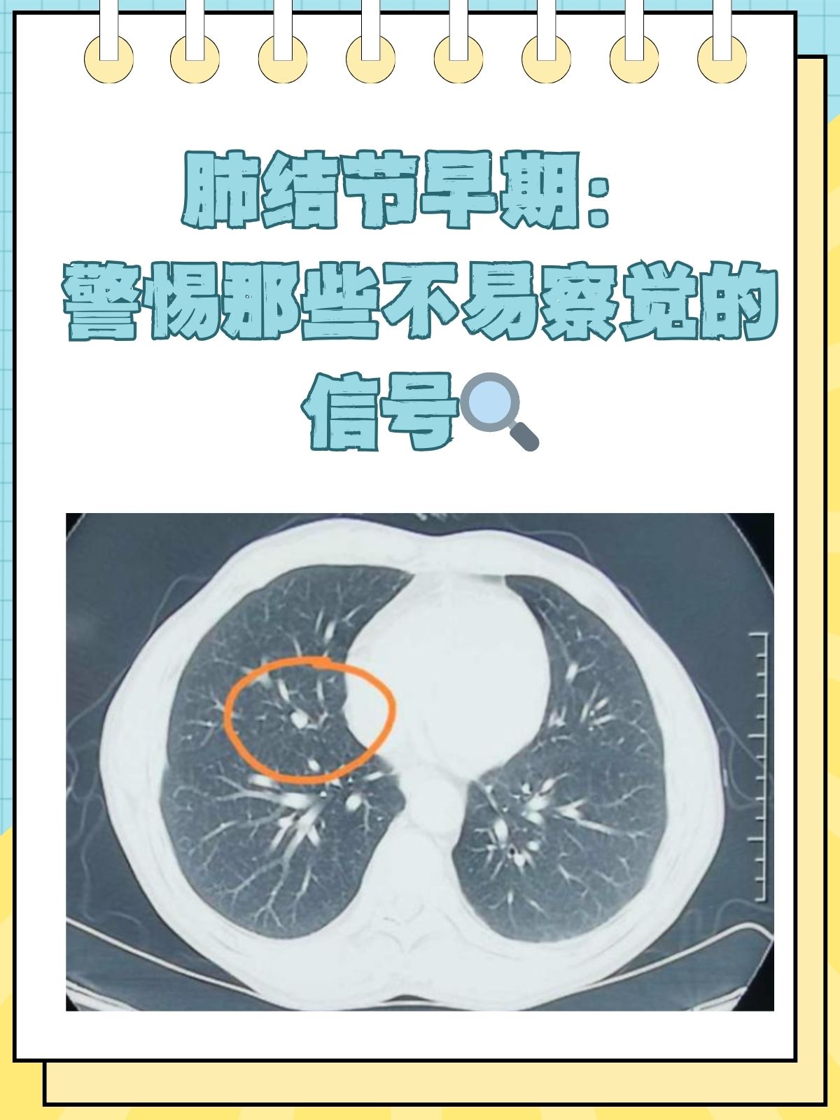 肺结节图片症状图片