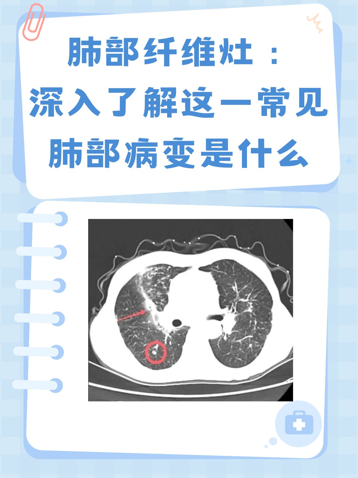 肺部纤维灶:深入了解这一常见肺部病变是什么 今天,我将带你深入了解