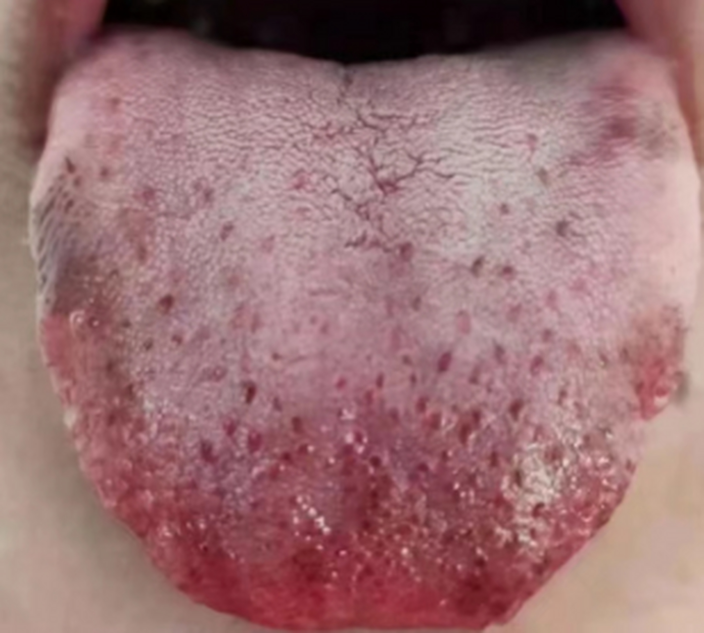 今日舌诊分享 一血瘀舌分象享 →这女的个是舌下静脉特别的粗,肝两胆