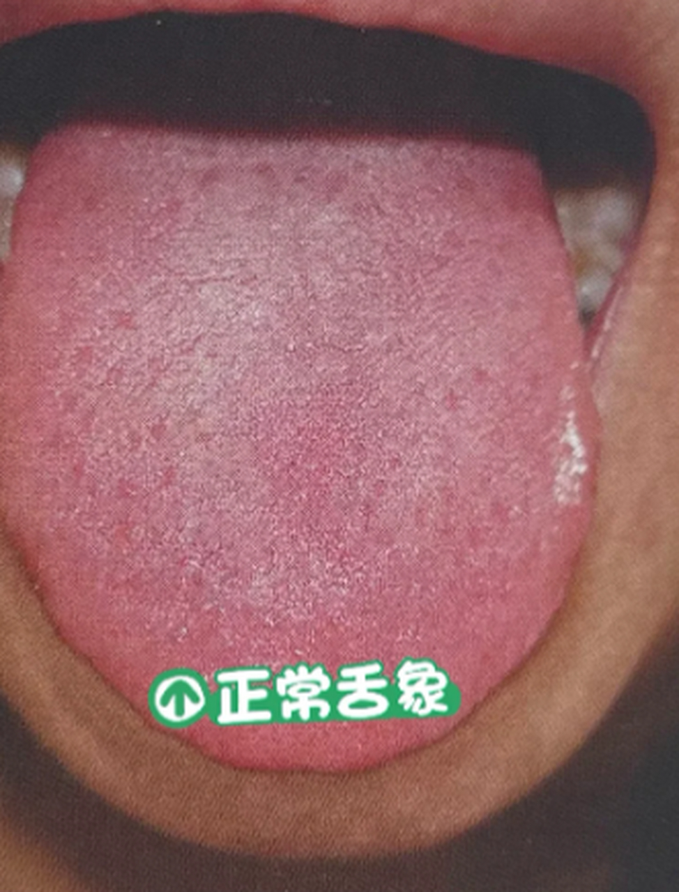 快来看看你的舌头吧 只有第一个是正常的, 你是属于哪一种?