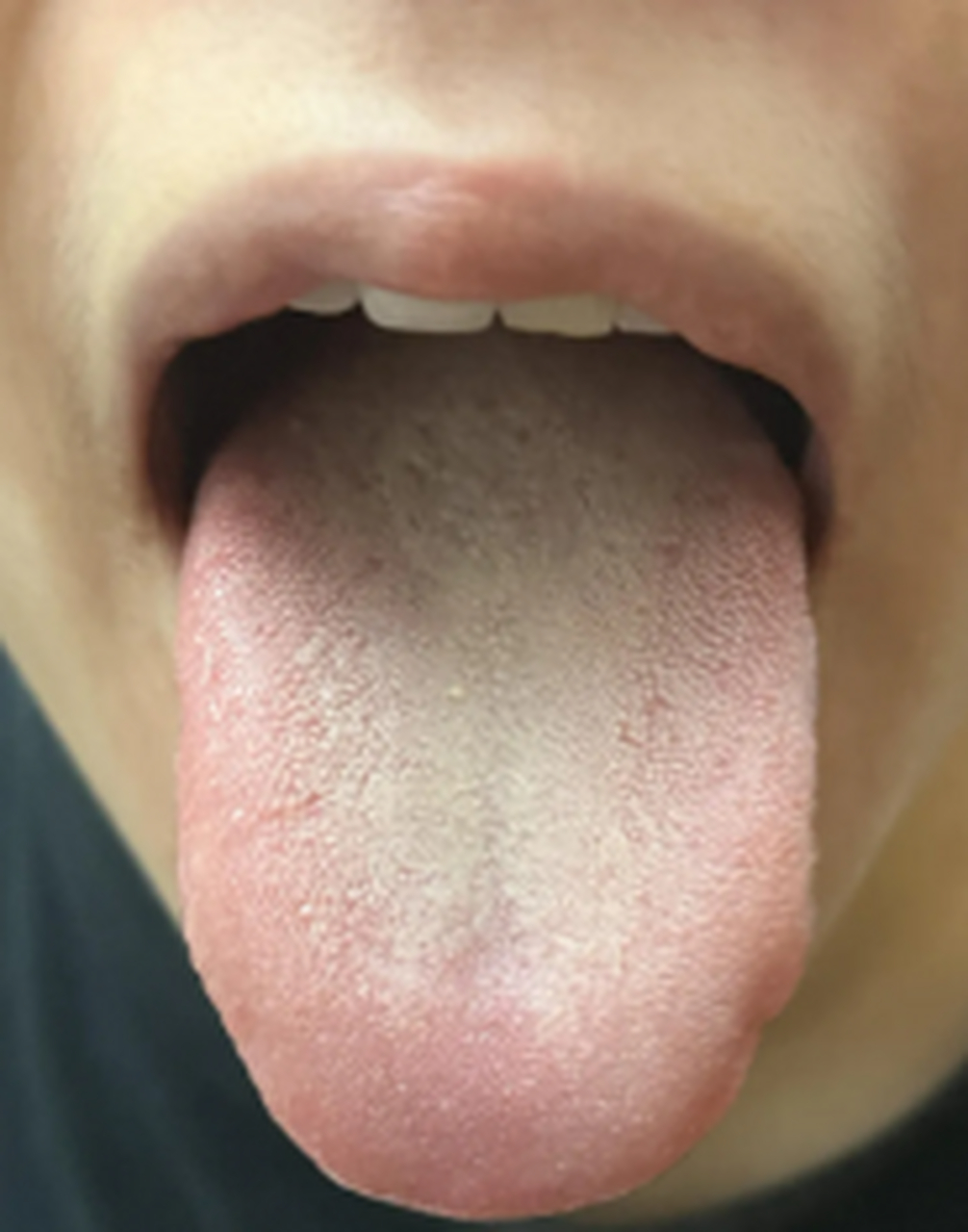 这是一位网友发来的舌象,女性30多岁,患者主诉最近尿频,失眠,牙痛