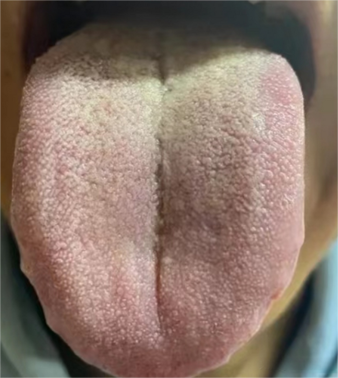 像他这种舌象,不要直接补,清利湿热才是重中之重  先看舌象,舌根苔黄