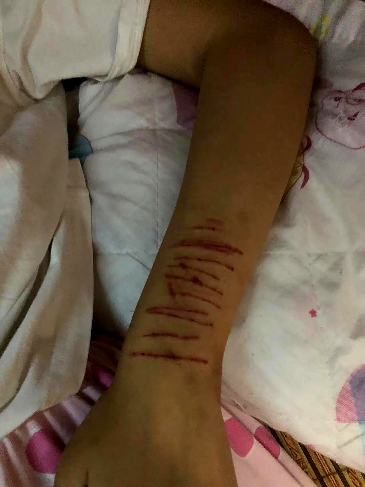 昨天,班里有个女生在教室里拿刀划手臂,血流不止