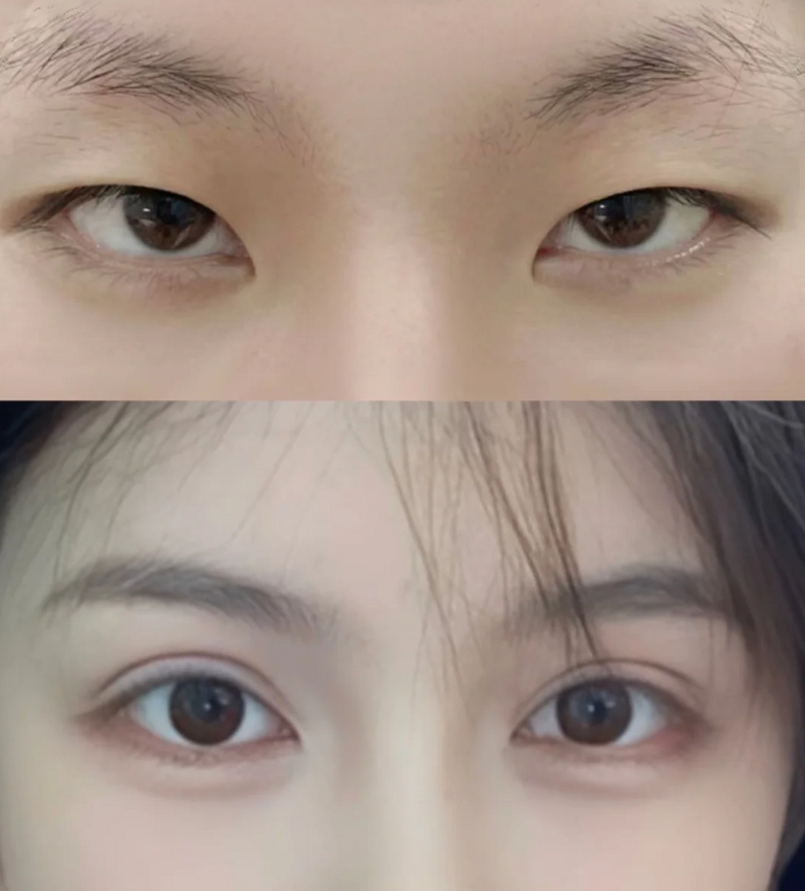 ① 平扇型双眼皮 重睑线与内眼角平行,内侧窄,外侧宽 眼头和平行型 