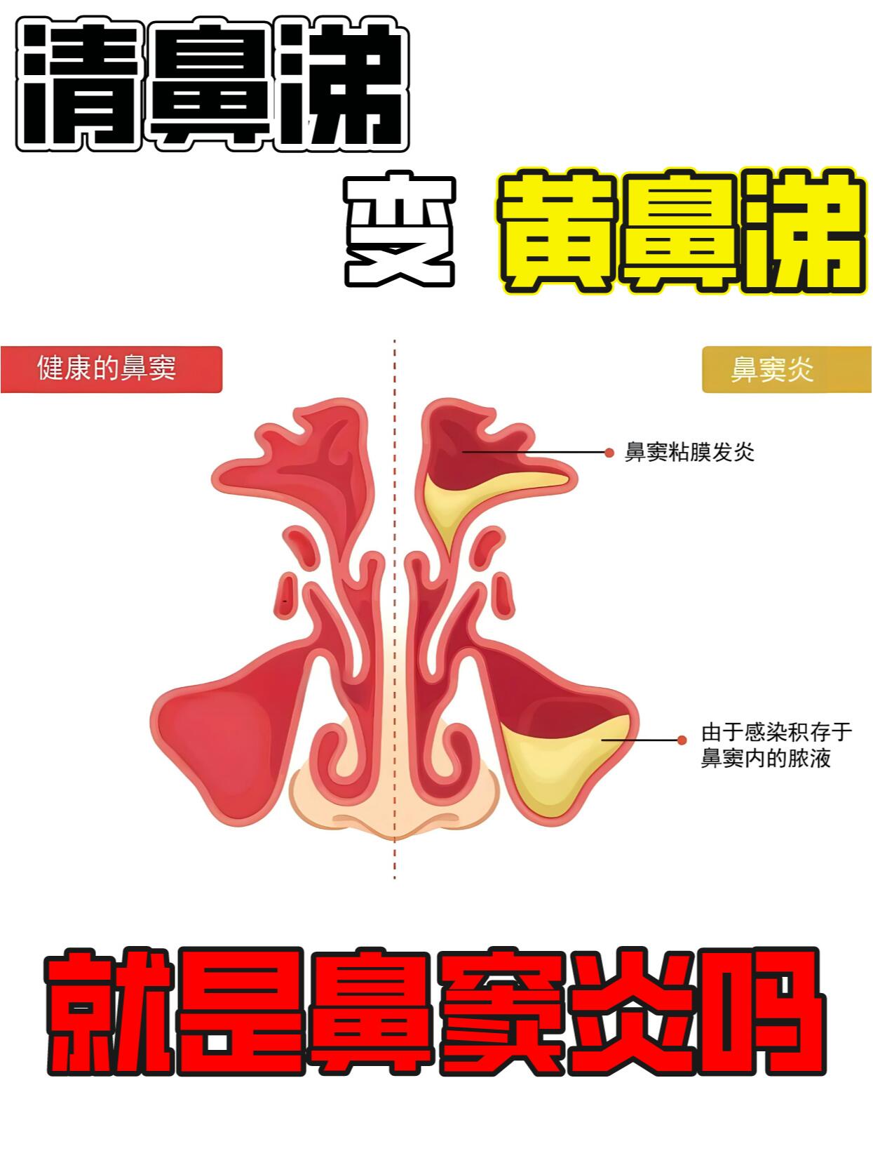 新生儿鼻腔狭窄图片