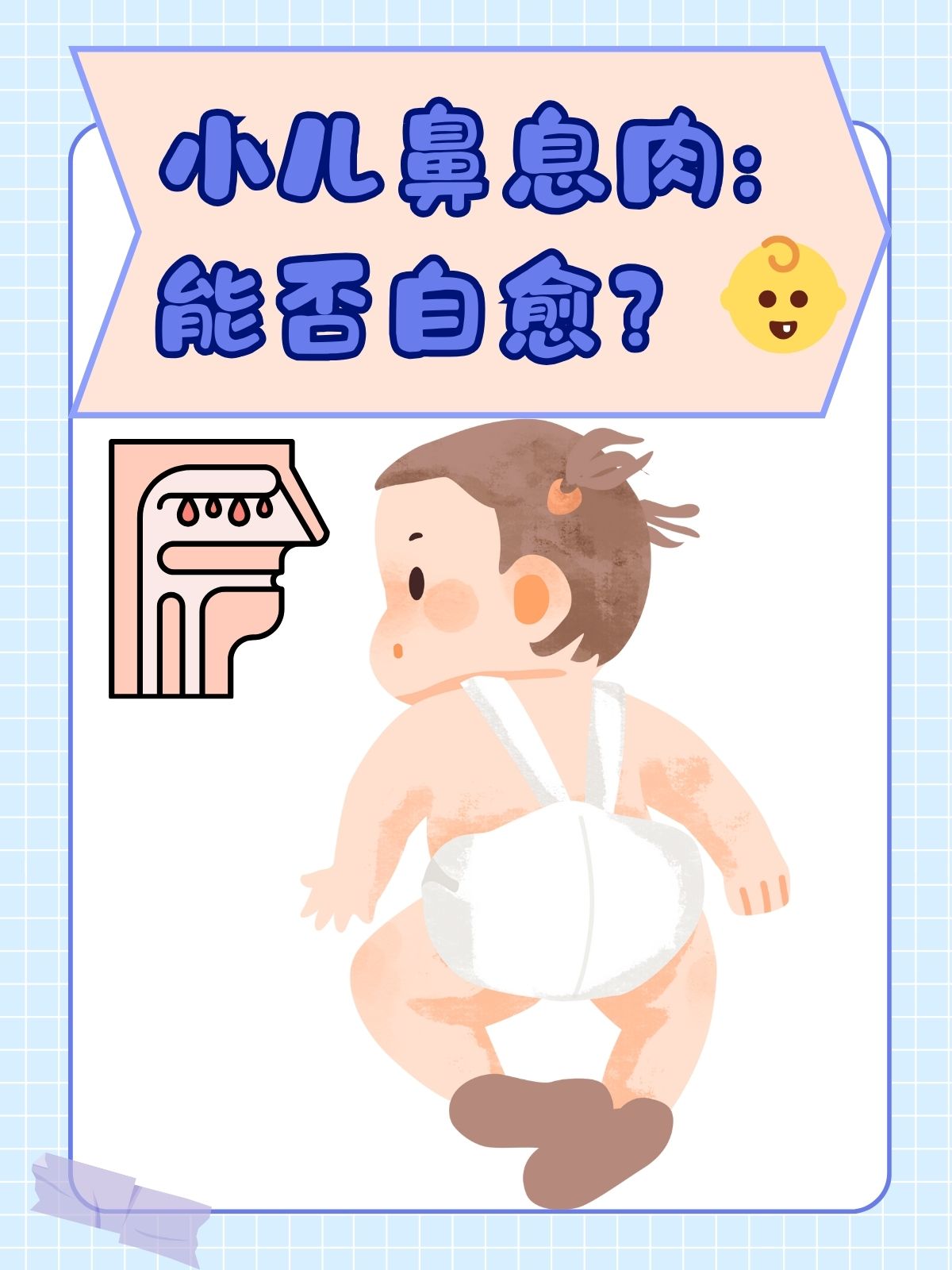 鼻息肉是发生在鼻腔内的非肿瘤性赘生物,多由慢性炎症刺激导致