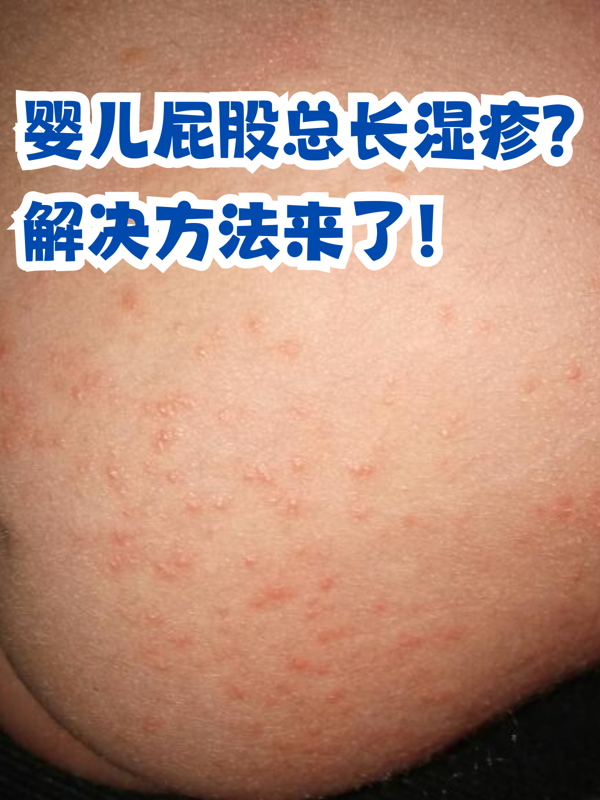 婴儿屁股总长湿疹?解决方法来了!