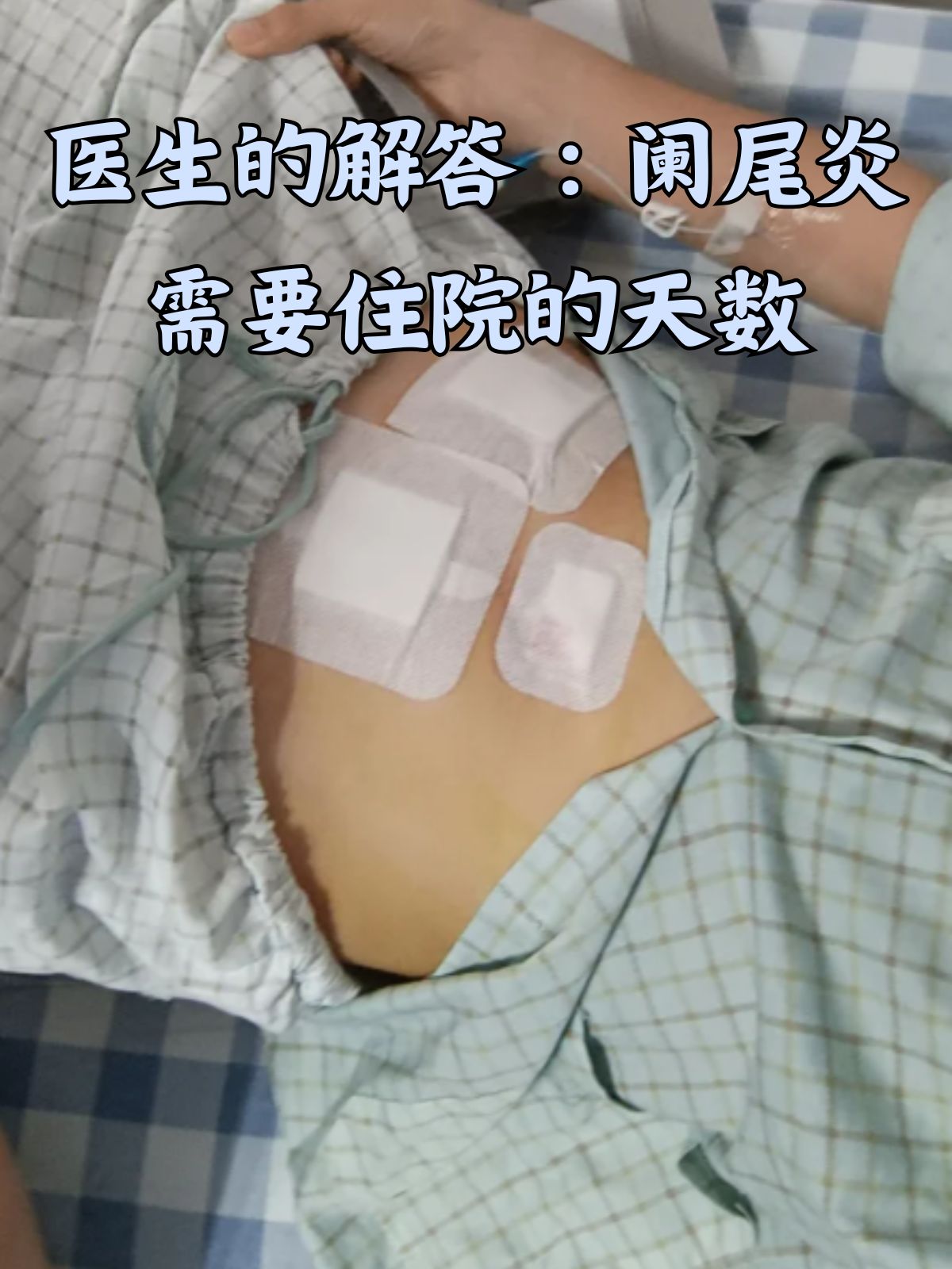 医生的解答:阑尾炎需要住院的天数 在日常生活中,阑尾炎作为一种常见