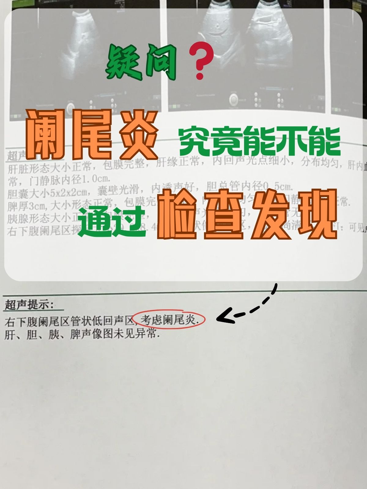 疑问阑尾炎究竟能不能通过检查发现?