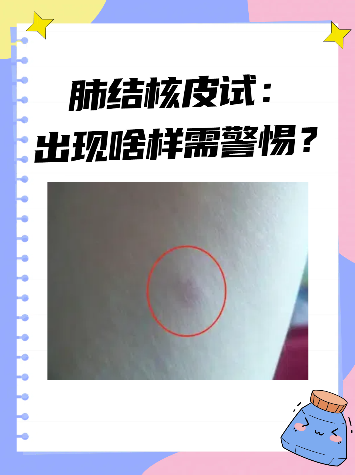 皮试结果并不能直接诊断肺结核,但确实能提供一定线索