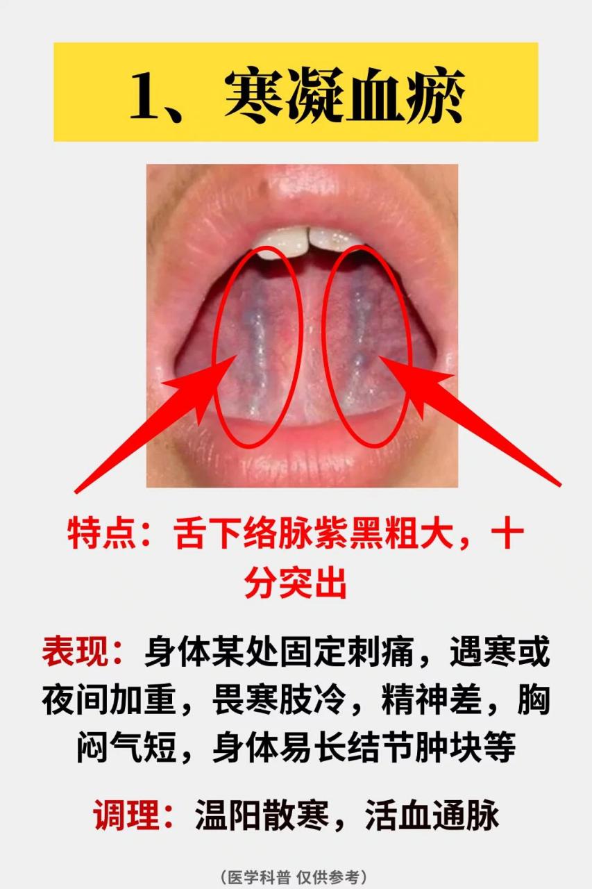 血瘀舌头图片比对图片