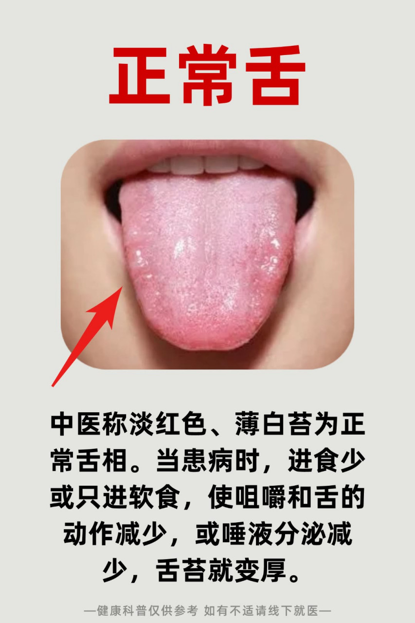 中医常见6种舌象,对镜自查,看你有没有 观舌条,辨体质 1,正常舌淡红色