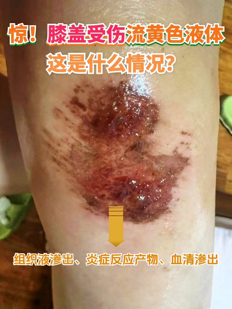 膝盖擦伤的患者,不少人会对擦伤后出现的黄色渗出液感到疑惑和担忧