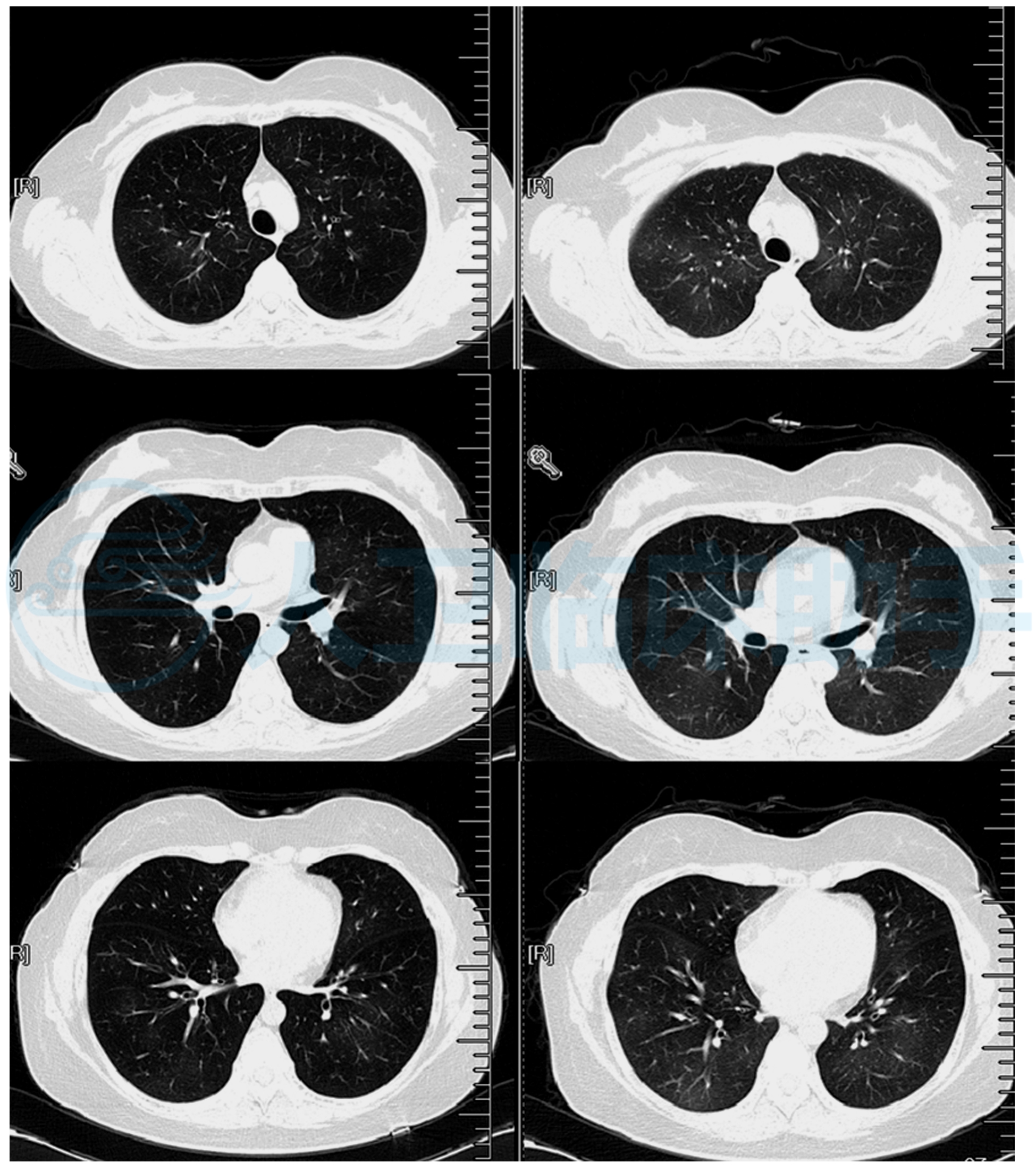 肺纹理增多:如同墙壁上的细小纹路,常见于长期吸烟者,工作环境差或