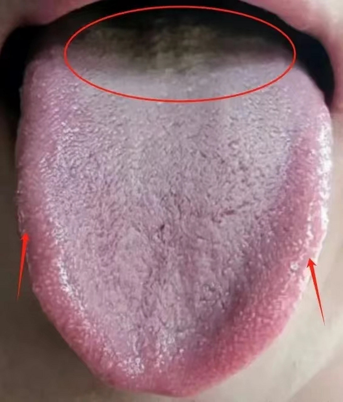 【舌象分析】舌尖红,舌苔白厚,上热下寒 舌两边鼓胀还红--肝郁化火