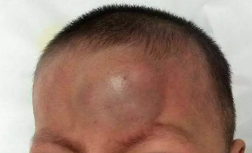 头上起包如何最快消除