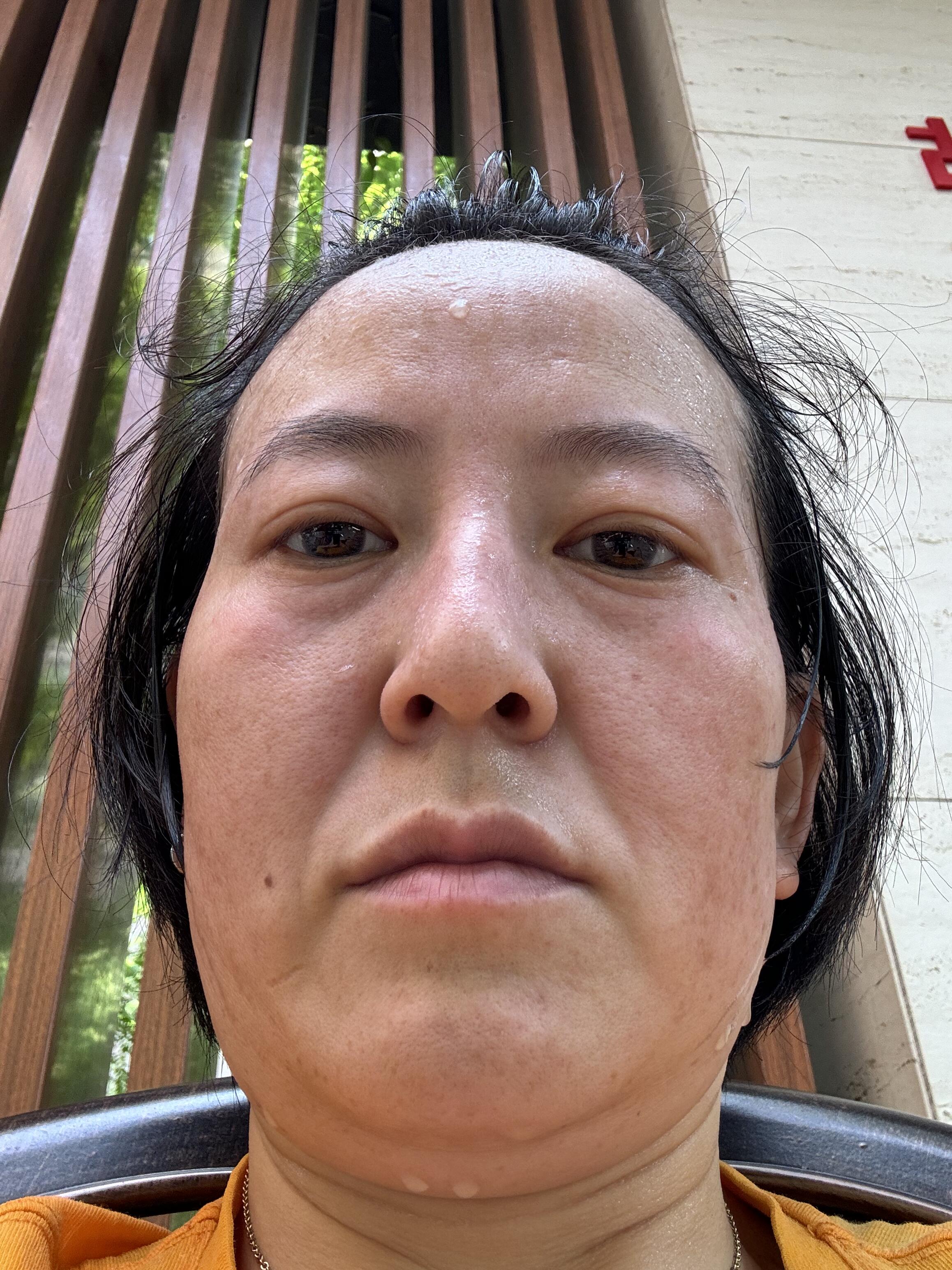由于我43岁调了法令纹结果老公说回到了初恋时刻……