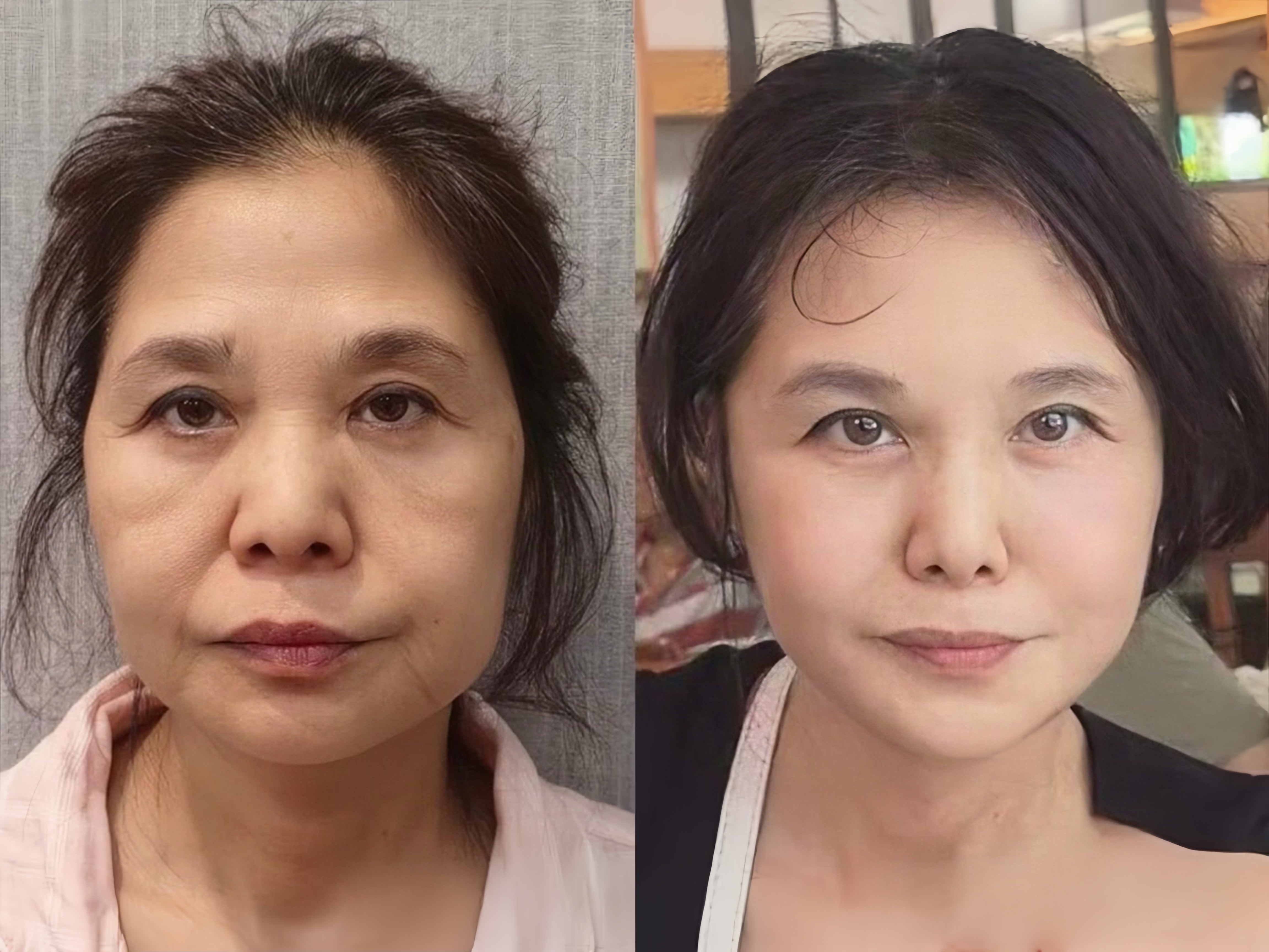 人面部比较甲状腺切除前后面容变化戒烟1