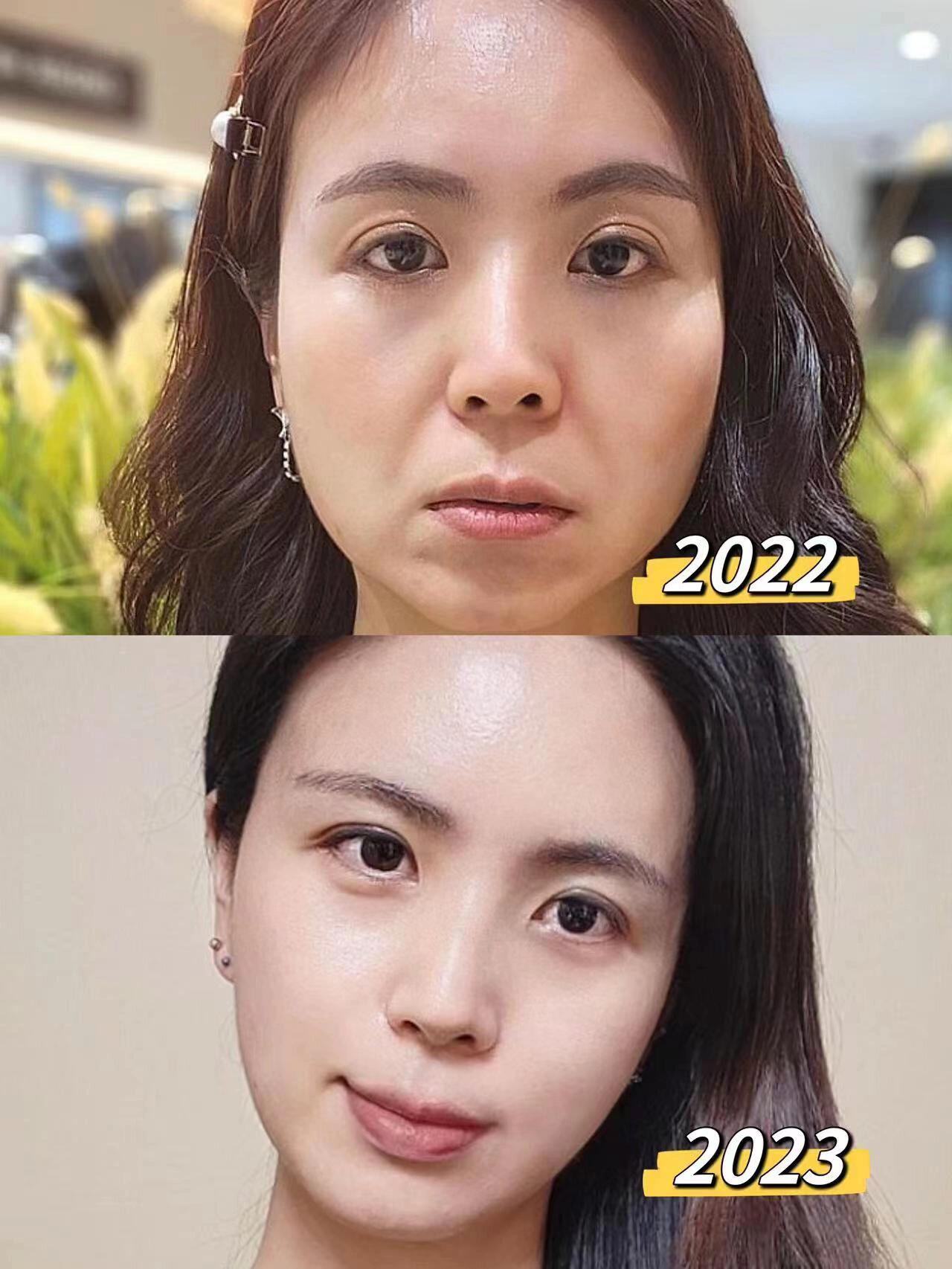 47岁,二婚老公给我出钱4万去做整容,你们看着效果值吗?