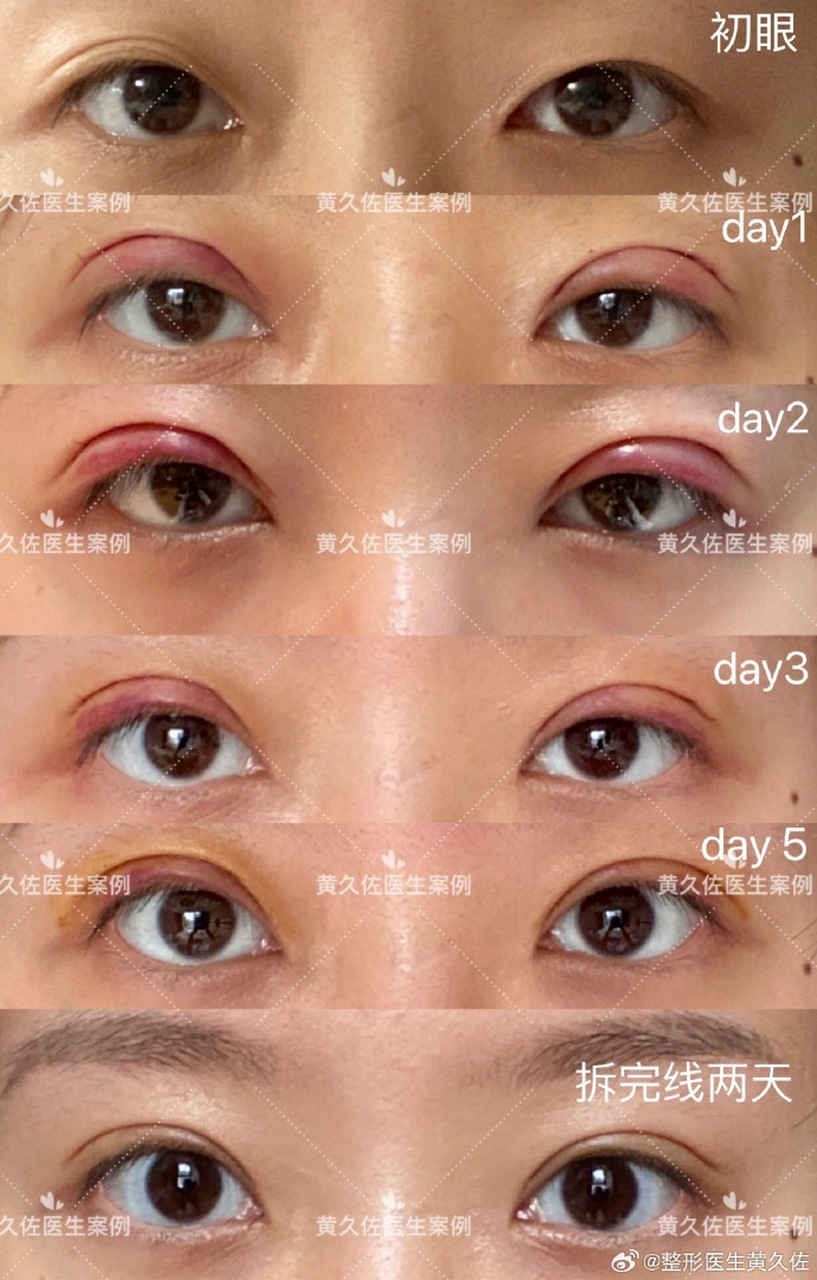 【全切双眼皮术后一年恢复】如下👇🏾:  下面是求美者记录的双