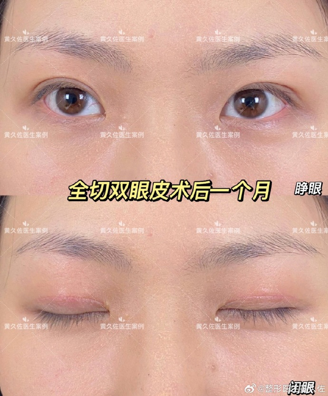 【全切双眼皮术后一个月】恢复情况  双眼皮术后是一个持续恢复的过程